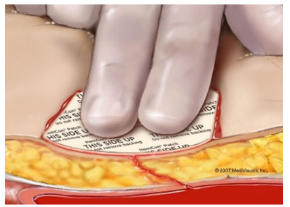 Hemostatic Patch 
